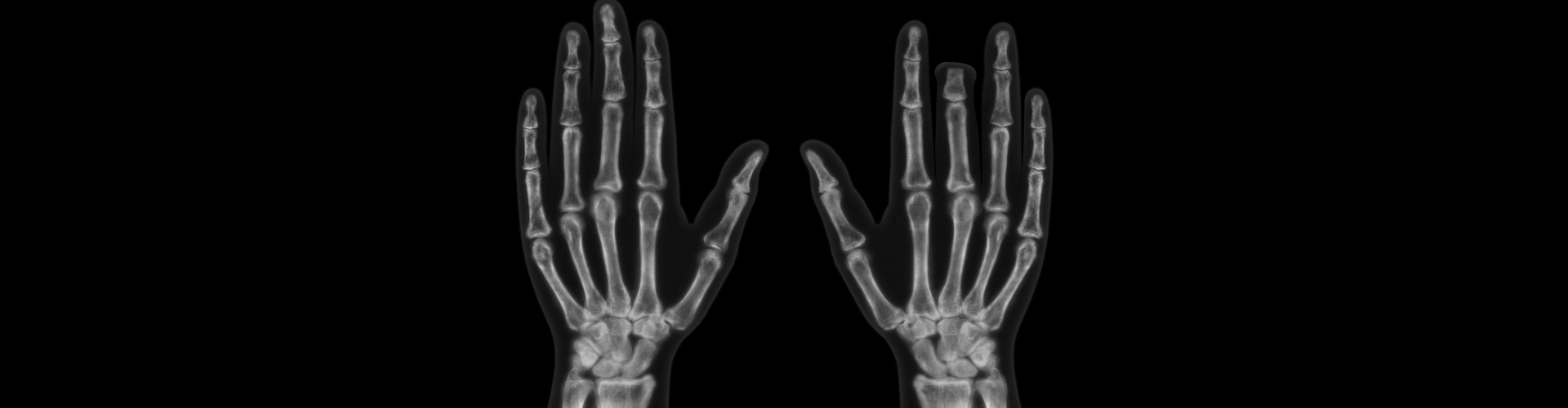 Door Finger Injury